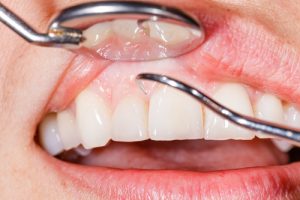 Peridontal (gum) disease